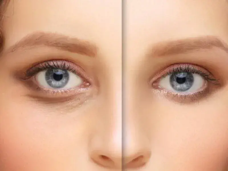 AUGENRINGE UNTERSPRITZEN