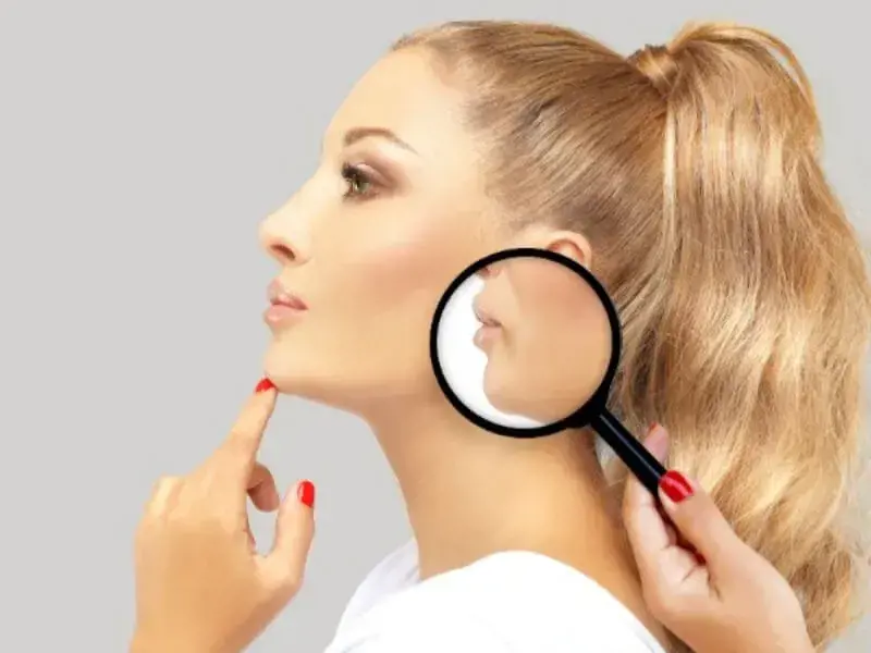 MUNDWINKELANHEBUNG MIT BOTOX